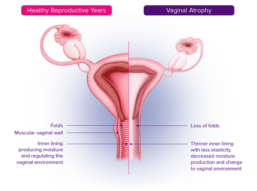 Ovesse Vaginal Atrophy Diagram